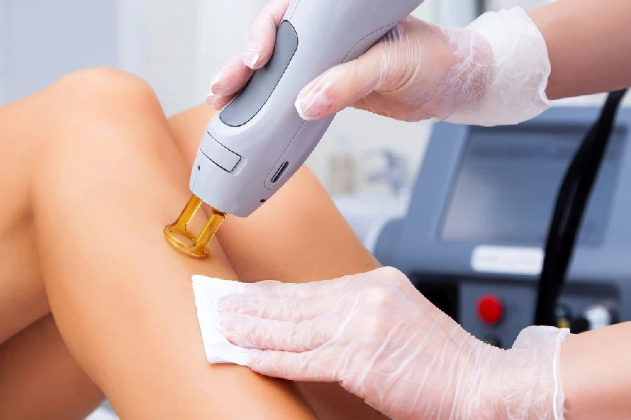 Smooth, ingrown-free skin after laser hair removal