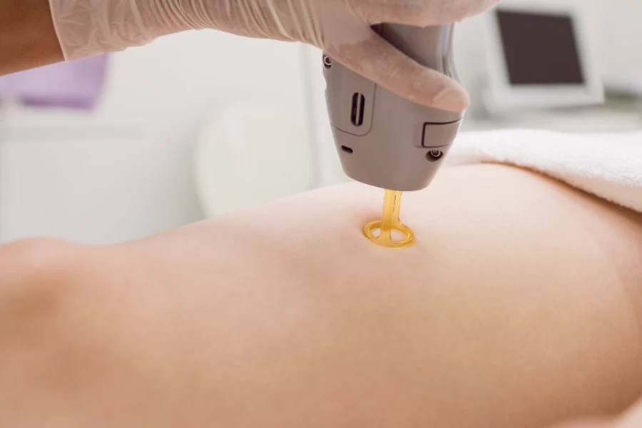 Nd:YAG vascular laser treatment in progress